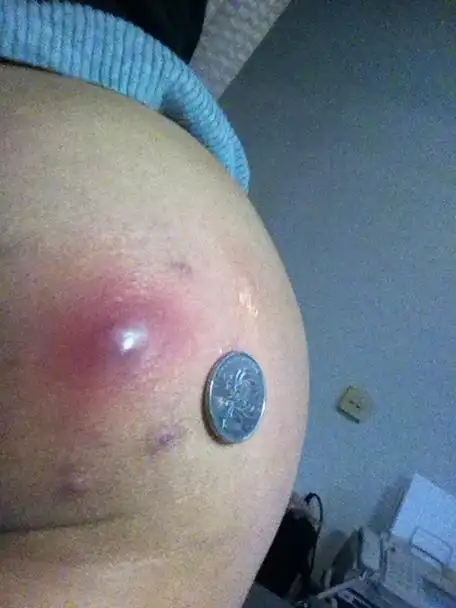 屁股上长火疖子图片