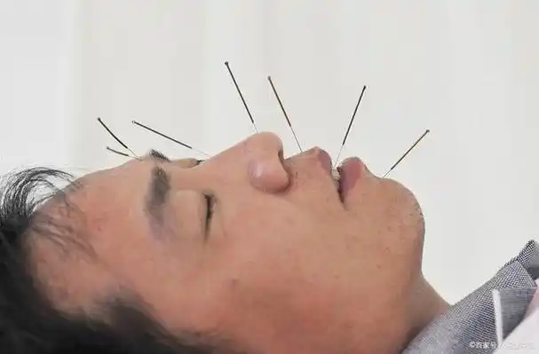 中医针灸治面瘫的经验分享