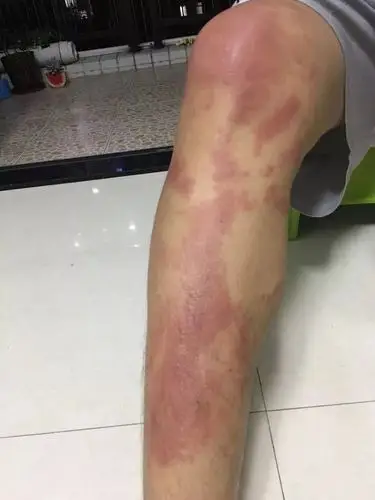 中山这家公园暗藏毒树8名游客中招皮肤大片红肿