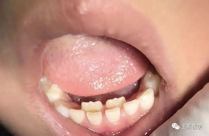 儿童出现双排牙怎么办