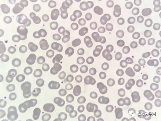 面对一份「高冷」的红细胞凝集标本,你会如何处理?