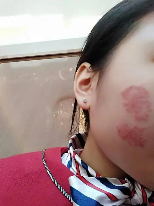 脸上红红一块,布满小红点,干燥脱皮