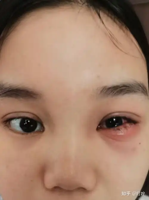 麦粒肿治疗的全过程