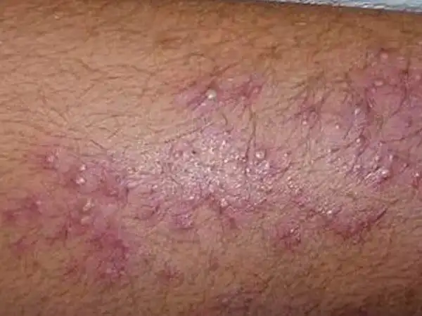 毛囊炎的症状图片是什么_毛囊炎_北京京城皮肤病医院(北京医保定点