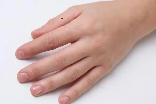 大拇指有痣好吗?