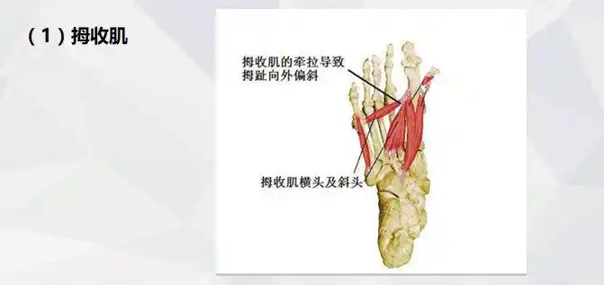 拇外翻的自我纠正