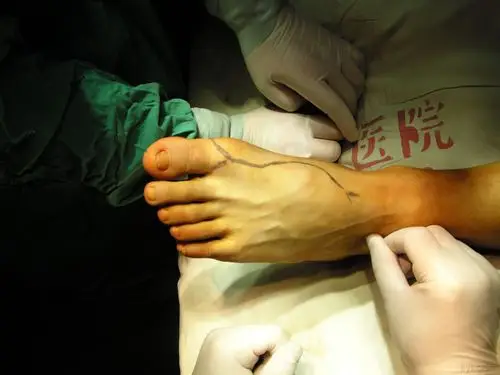 大脚趾再造拇指改良 - 骨科与显微外科专业讨论版 - 爱爱医医学论坛