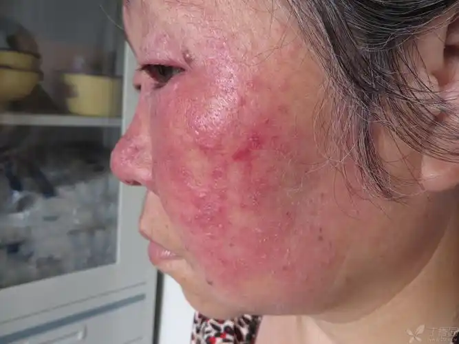 【请教】中药洗出来的面部接触性皮炎?