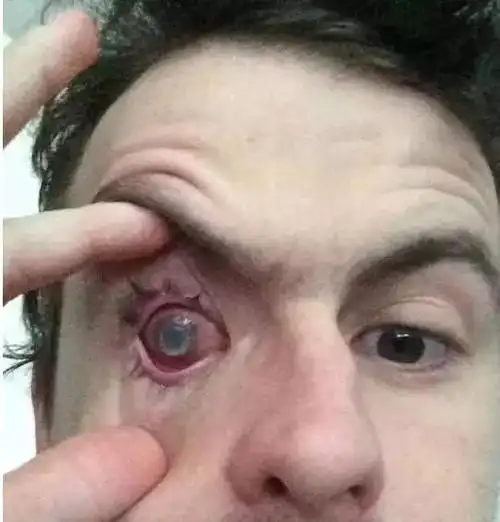 恐怖这个人类最伟大的发明竟会让你眼睛长寄生虫