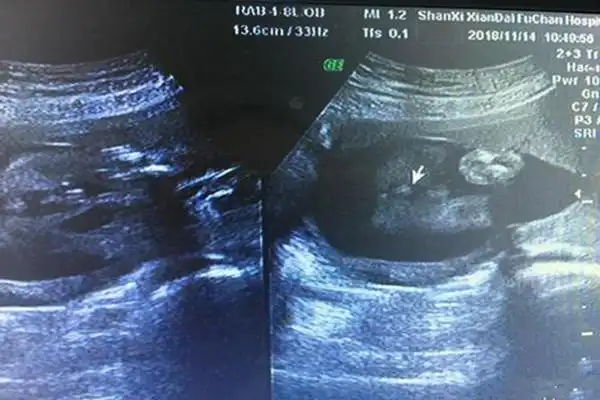 生男生女彩超单暗示男胎儿小鸡四维显示图"七星高照"-第2张图片-玫红