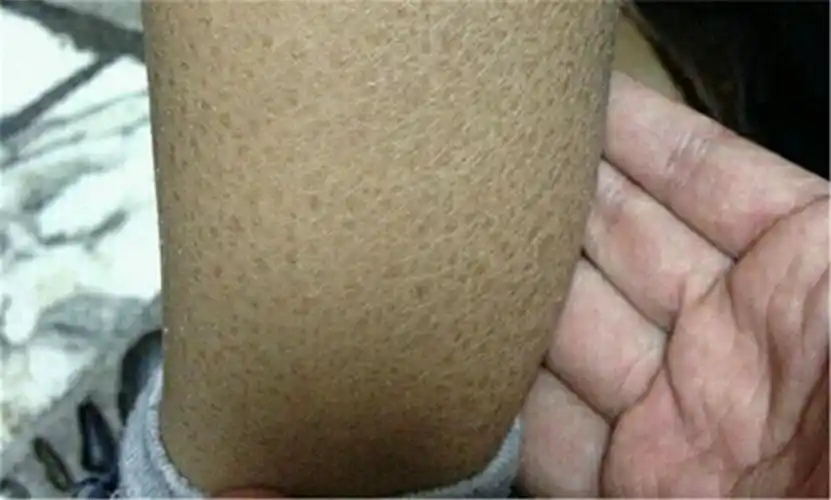 鱼鳞病图片_鱼鳞病症状表现图片大全_有来医生