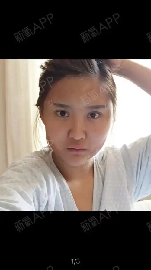 全脸脂肪填充术后第一天