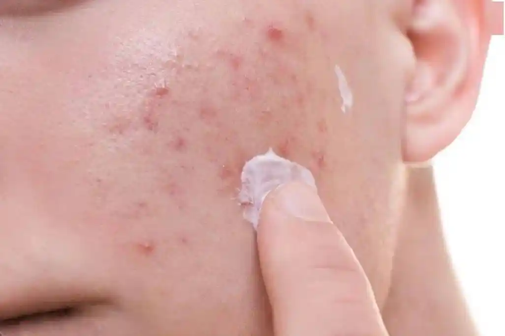 油敏肌护肤指南_肌肤_皮肤_屏障