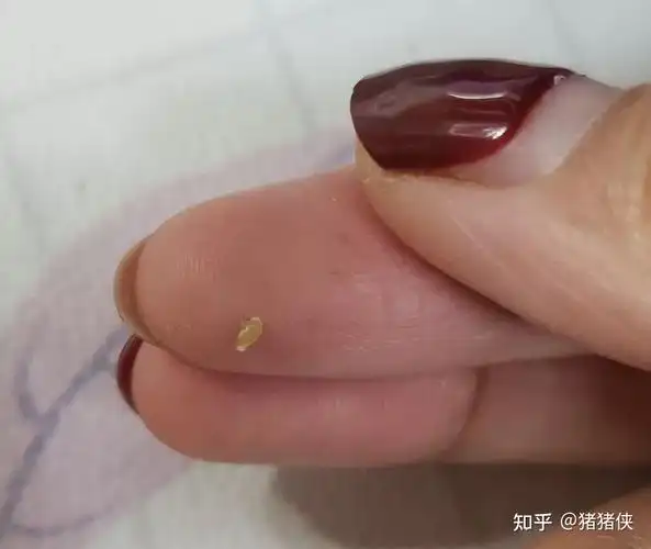 就是无数个洞里面都填满了脂肪粒,俩指甲挤着两边稍微用点力,就把它一