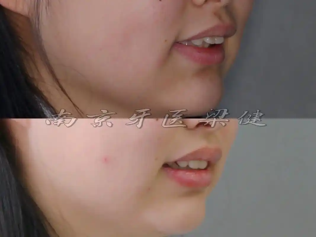 青少年下颌嘴突合并后缩的正畸治疗.