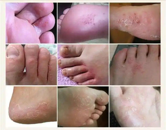 治脚气止痒药膏喷剂除脚臭香港脚脚汗脱皮脚痒水泡型脚烂脚汗软膏