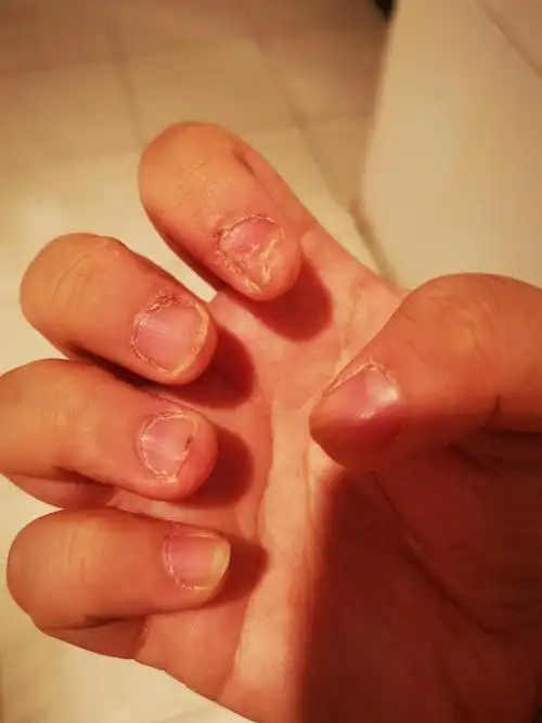 指甲咬烂十五年,救救孩子