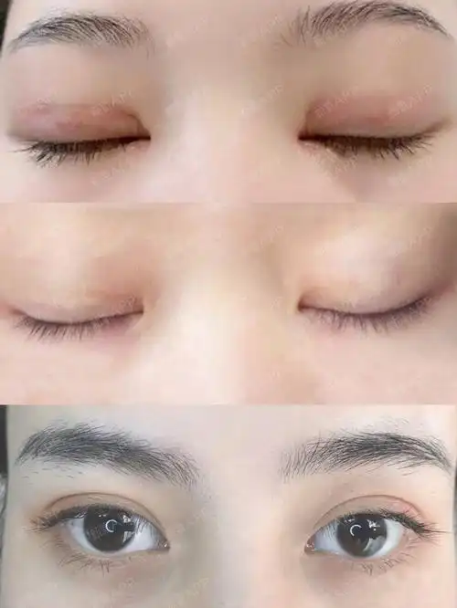 全切双眼皮!5个月分享