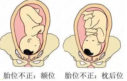 胎儿入盆后胎位还会变吗