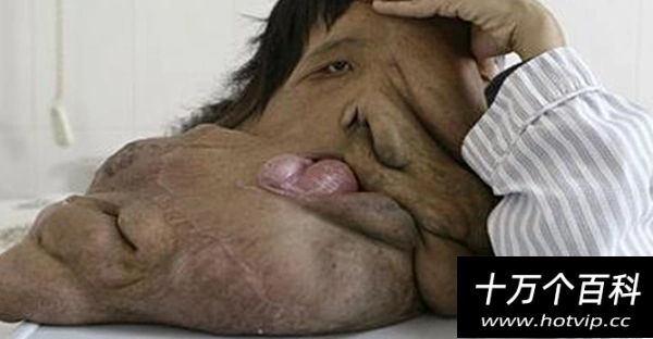 世界上长得最恐怖的人:湖南象人黄春才(脸上15公斤神经纤维瘤) - 火烩