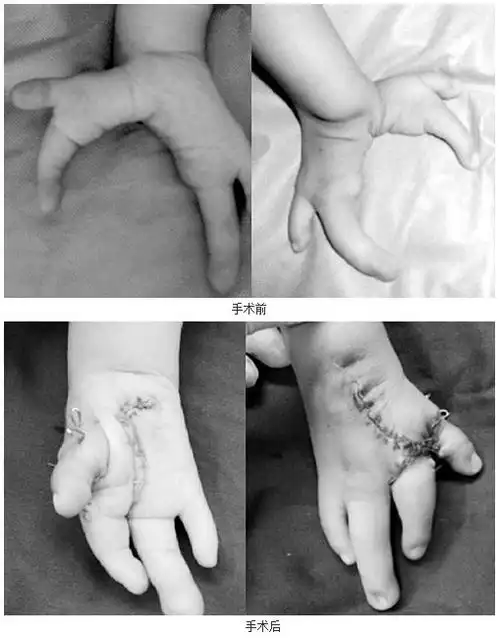 幼儿双手畸形如龙虾钳 或因母亲孕期受辐射所致