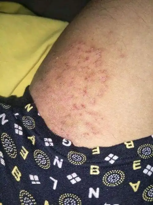 夏季癣病高发,如何科学防治?