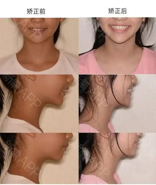 矫正前后面像对比