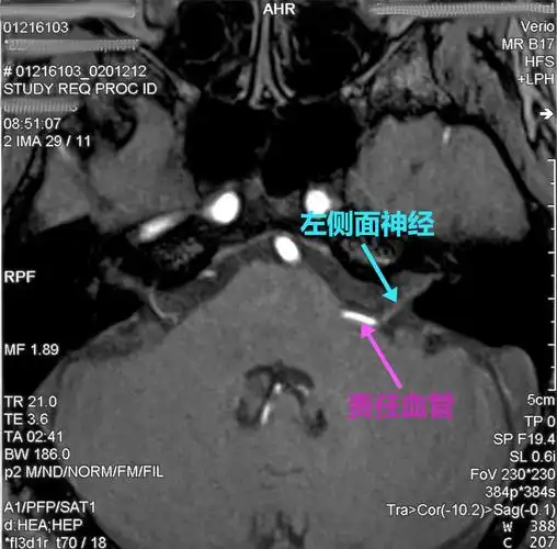 如何治疗恼人的面肌痉挛?