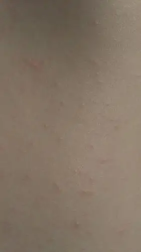 后背起了一片小疙瘩 一抓就变红变大了 前一段时间心买了件小吊带