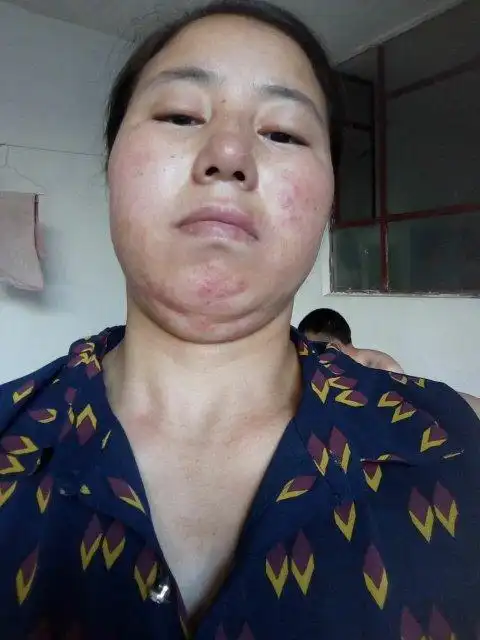 下巴长痘 痘,右脸长,密密麻麻,流黄水,请问皮夫