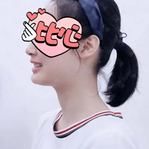 牙齿矫正后的侧脸