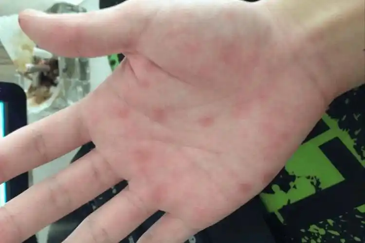 体内有癌手掌先知?告诫:若同时出现这些症状,早去检查还不算晚