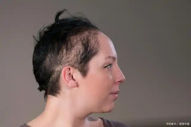 为什么说"拔毛癖"比"熬夜秃头"更可怕,因为前者是