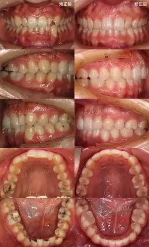 矫正前后口内像对比