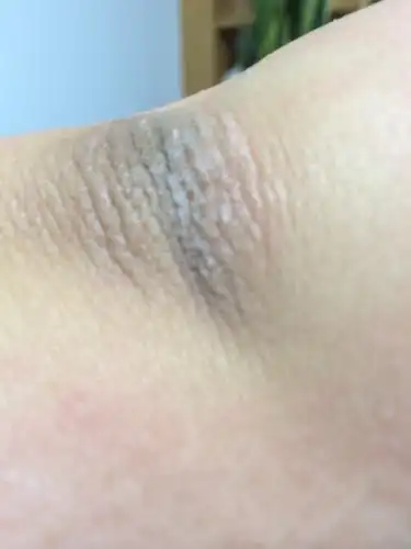 胳膊肘上皮肤异常见照片,没什么疼痒感觉,只是很粗糙.