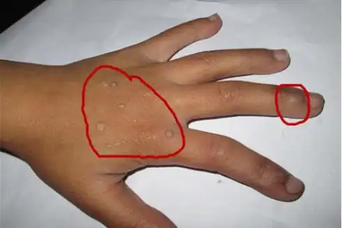 疣的种类及图片