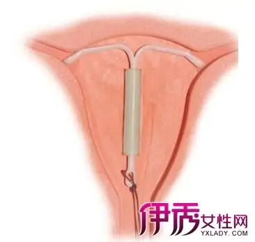 【女性上环图片】【图】可怜的女性上环图片 危害大要慎重选择_伊秀