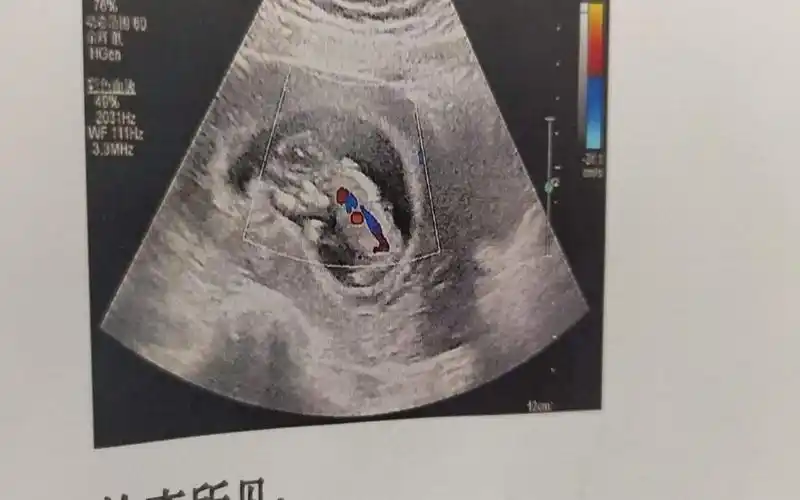 nt图上有三条线是不是生女孩的几率更大?