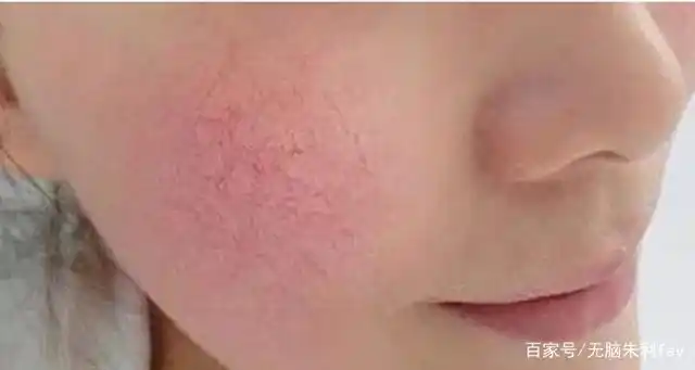 角质层薄脸发红发热用什么护肤品