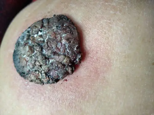 老太太右侧肩背部的大瘊子