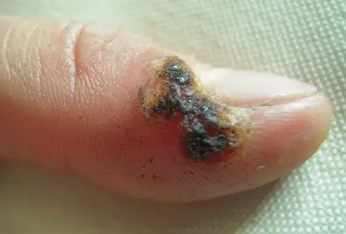 指甲盖旁长黑点,不要随意剪