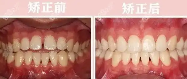 舌侧牙齿矫正前后对比照