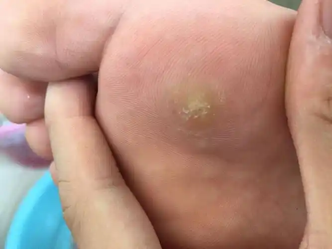 肉刺长什么样子图片 肉刺长什么样子图片初期