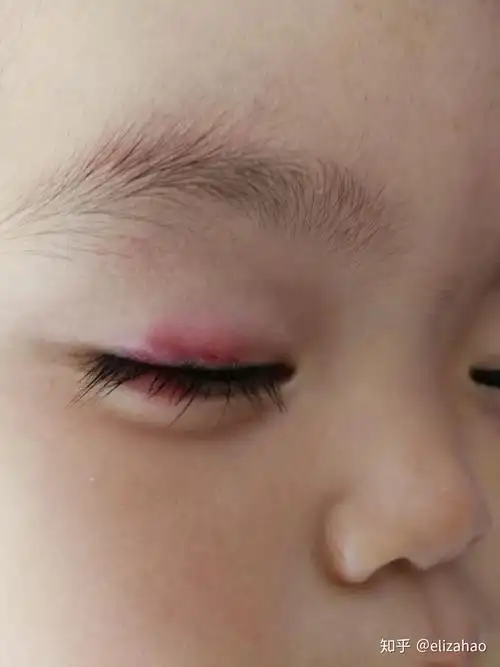 儿童麦粒肿治疗经历