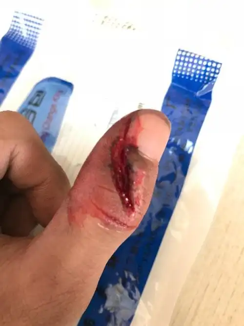 大家好,这样的伤口需要打破伤风吗,谢谢!