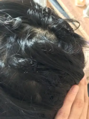 我接头发有两个月了,今天发现头发里头有白色的发根,已经离开头皮了