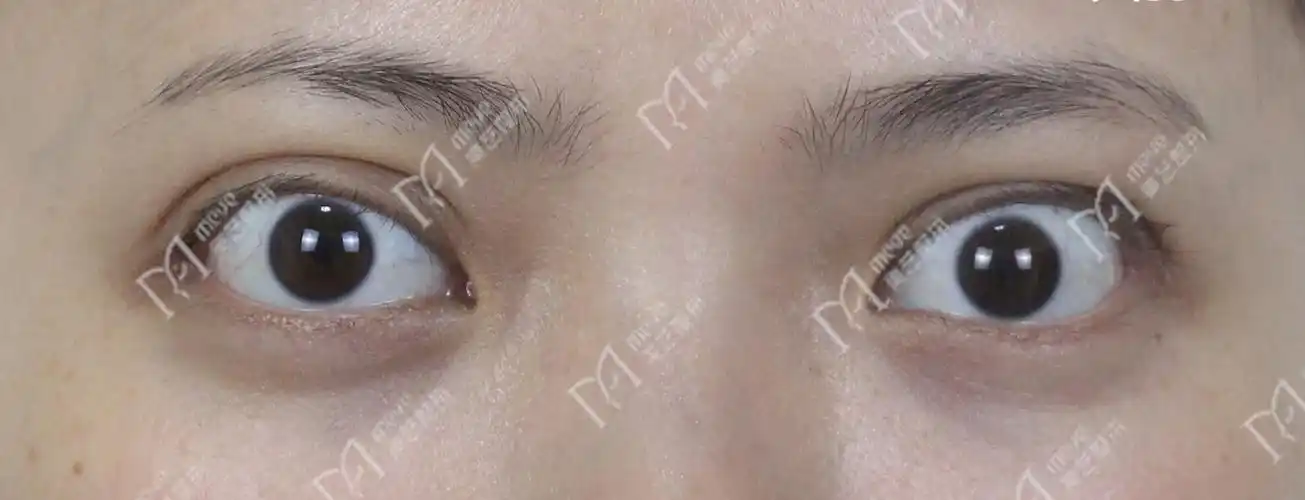 上眼睑退缩也不要忽视