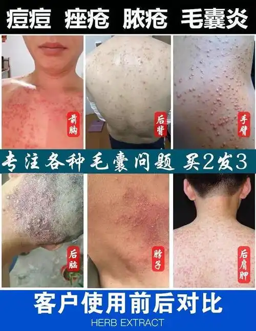 治毛囊炎药膏头部头皮背部脸部脓疮包痤疮痘痘止痒膏皮肤瘙痒特效 一