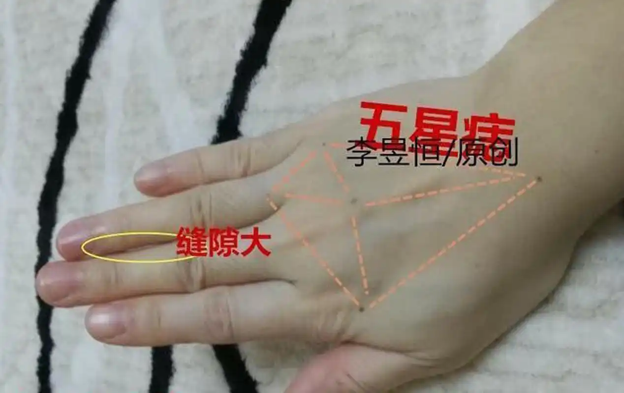 第一,五星痣:手背掌面五星痣,代表一般代表倾向于技术或者学术行业