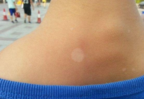 汗斑早期症状图片58